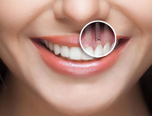 چطور بهترین کلینیک دندانپزشکی اصفهان را برای ایمپلنت پیدا کنیم؟