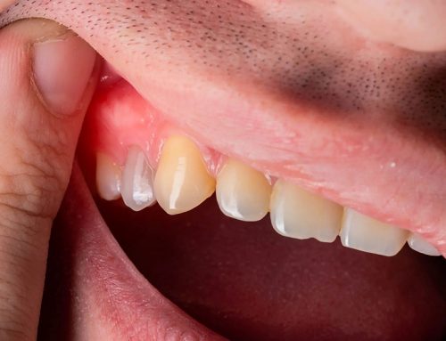 درمان آبسه دندان چیست؟ ۱۰ روش پزشکی و خانگی درمان بدون خطر آبسه