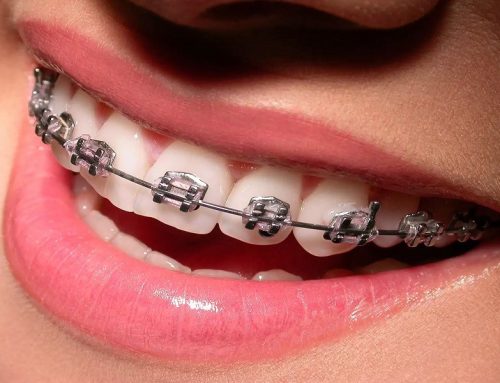 ارتودنسی چیست و چه تأثیری بر سلامت دندان ها دارد؟