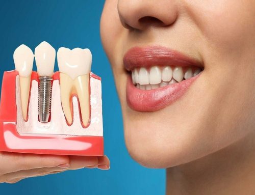 آیا دندان ایمپلنت خراب میشود؟ همه چیز درباره مراقبت از ایمپلنت