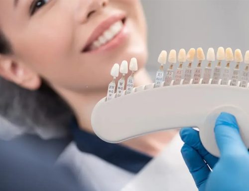 تفاوت کامپوزیت و لمینت دندان؛ کدام روش محبوب زیبایی را انتخاب کنیم؟