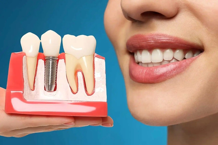 ایمپلنت برای بیماران دیابتی