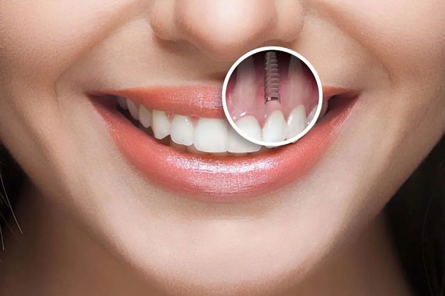 ایمپلنت برای بیماران دیابتی