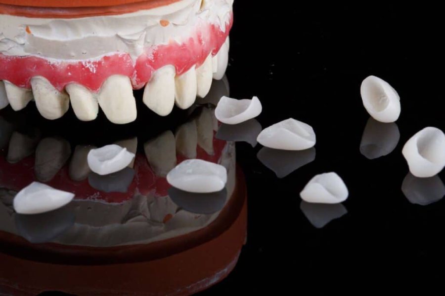 لمینت دندان بدون تراش