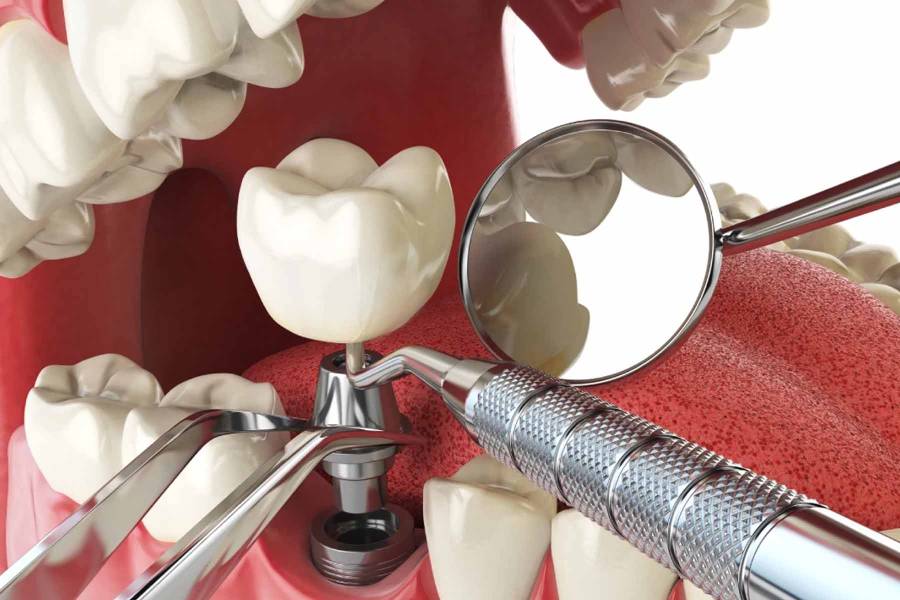 بهترین سن انجام ایمپلنت