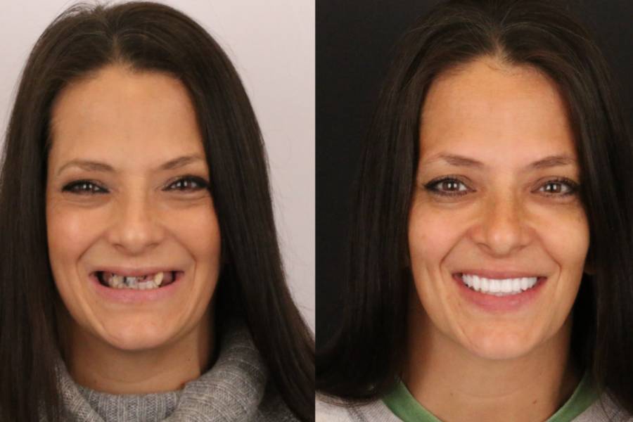 بهترین سن انجام ایمپلنت