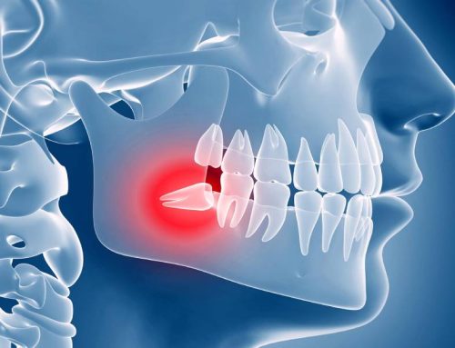 چرا دندان عقل داریم و چرا باید آن را بکشیم؟