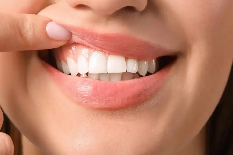 لبخند لثه ای