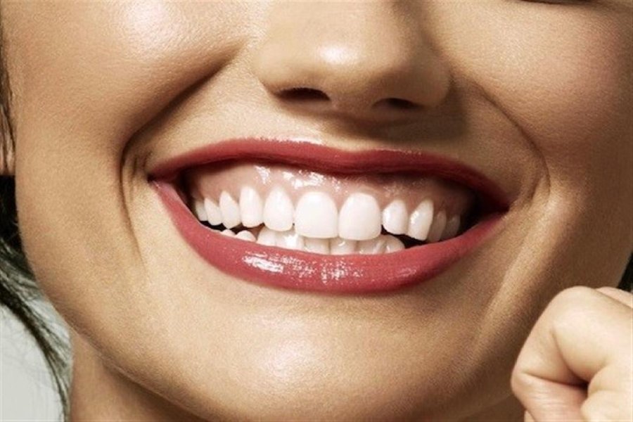 لبخند لثه ای
